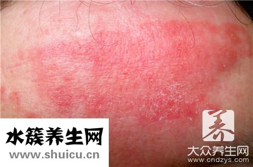 湿疹脱皮