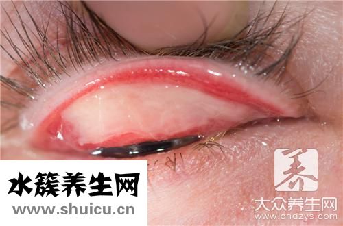 过敏眼药水