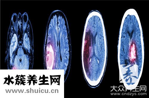 肝性昏迷