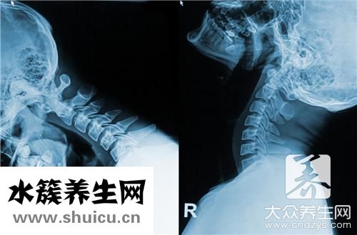 颈椎病会引起胸痛吗