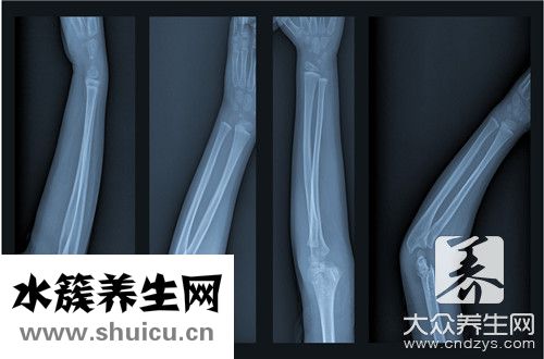 髋臼骨折
