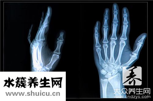 髋臼骨折