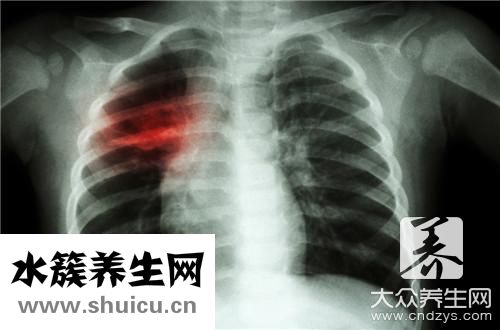 开放性肺结核
