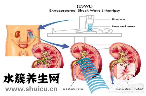 尿路感染会不会传染吗？尿路感染会传染吗