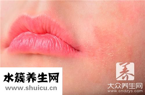 激素性皮炎能自愈吗