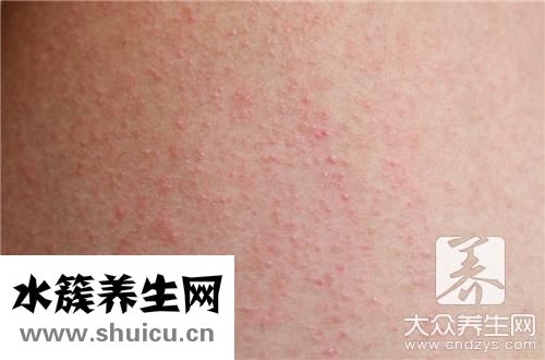 小红疙瘩