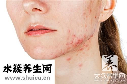 治疗痘坑痘印