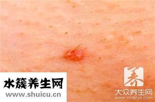 毛囊炎涂什么药膏最好