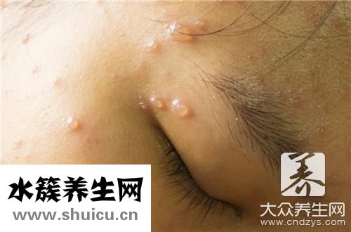 脸上痘坑填平