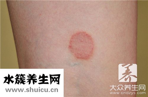 玫瑰湿疹