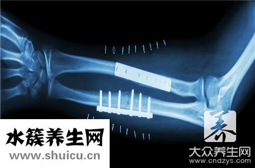 骨折需要忌口东西