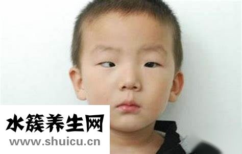 斜视如何治疗（斜视眼怎么治疗最佳）
