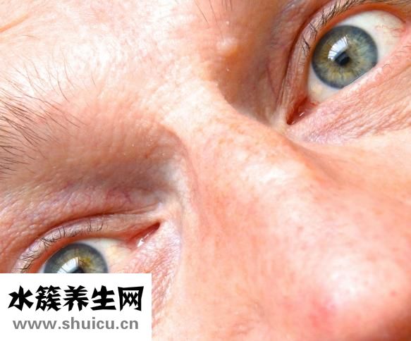 下眼皮皱纹