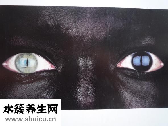 早上起床眼睛浮肿
