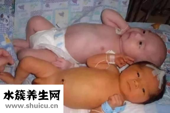 婴儿黄疸怎么处理