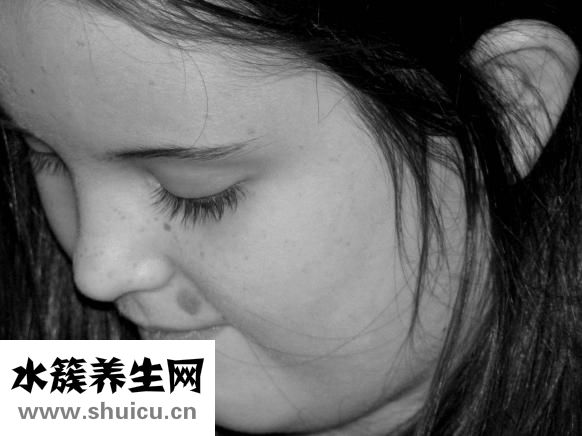 腺样体面容图片