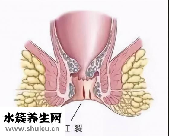 痔瘘是什么症状