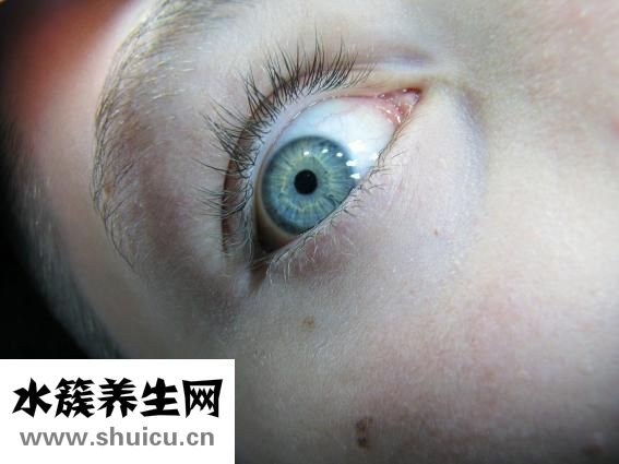 怎么虹膜变异