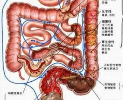 结肠炎有哪些症状，慢性结肠炎的五大症状