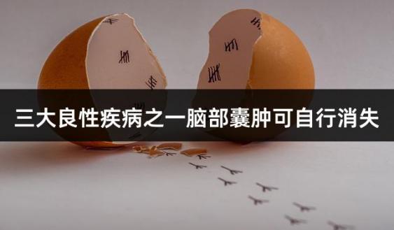 三大良性疾病之一脑部囊肿可自行消失