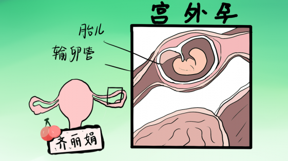 宫外孕症状早期，宫外孕早期症状有哪些？