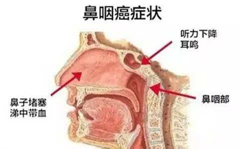 鼻咽癌是怎么引起的，为什么会得鼻咽癌？