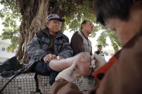 麻风疫苗，麻腮风疫苗是什么？