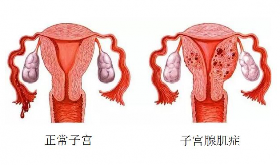 腺肌症有什么症状，武汉出现起确诊病例