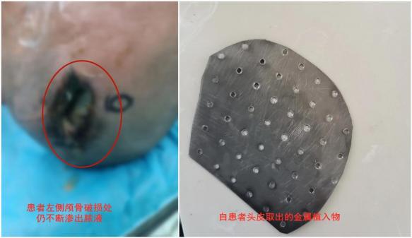 渗出液和漏出液，武汉出现起确诊病例