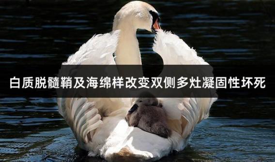 白质脱髓鞘及海绵样改变双侧多灶凝固性坏死
