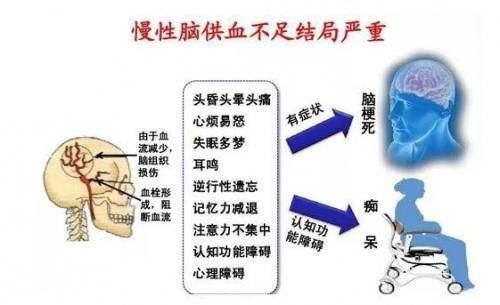 脑供血不足有三大症状，脑供血不足有三大症状吃什么药