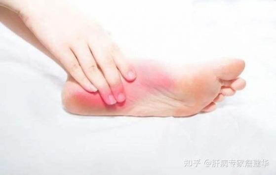 肝不好的人看脚就知道，肝不好的人看脚就知道不好