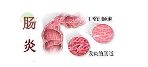 肠胃炎有什么症状，十二指肠胃炎有什么症状