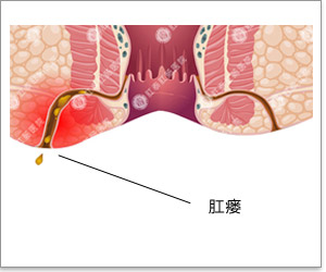 肛瘘前期小疙瘩图片（肛瘘初期症状图片）