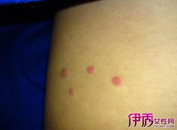 hiv初期淋巴肿大位置图腿部（hiv初期淋巴肿大位置图）