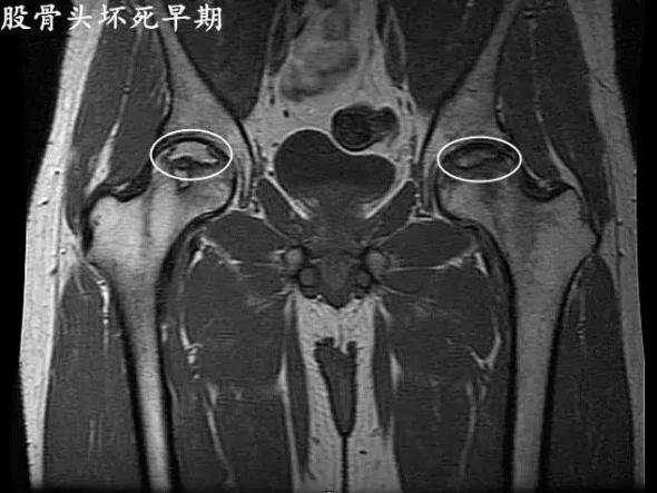 股骨颈骨折后股骨头坏死早期症状（股骨头坏死早期症状）
