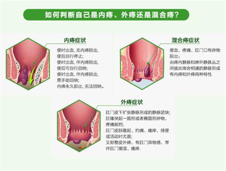 肛门口有个肉球突出是怎么回事（如何判断自己是不是得了痔疮）
