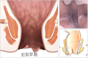 肛裂的症状治疗方法（肛裂的症状）