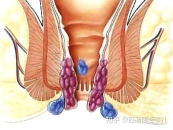 肛瘘是什么症状图片大全（肛瘘啥症状图片）