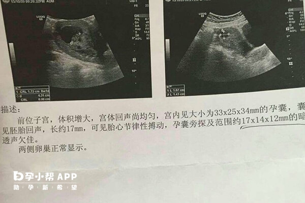 8个症状暗示宫外怀孕了（孕早期最快判断宫内孕）