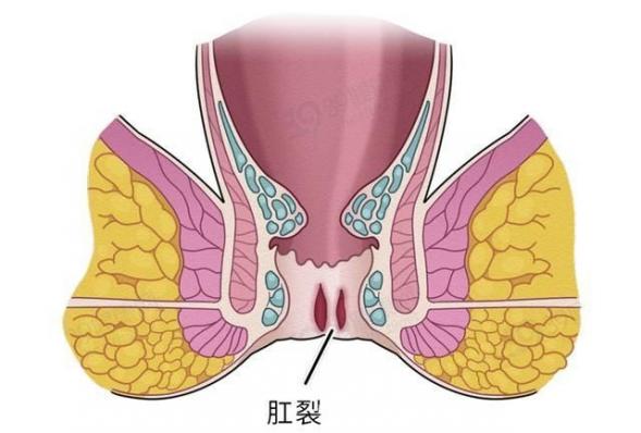 早期肛瘘的清晰图片（我用碘伏治好了肛瘘）