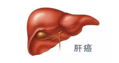 肝癌病人要走前的征兆清肠（肝癌病人要走前的征兆）