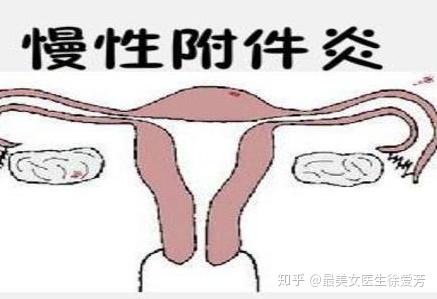附件炎有2个明显症状疼痛（附件炎有2个明显症状）