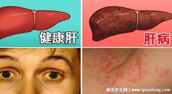 肝不好身上有三处发痒吗（肝不好身上有三处发痒）
