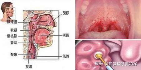 急性咽炎一般几天恢复（怎么区分是咽炎还是扁桃体炎）