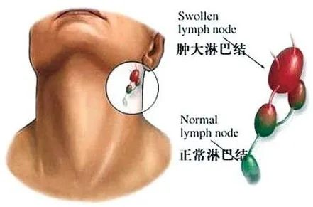 颈部淋巴肿瘤的早期特征图片（颈部淋巴肿瘤的早期特征）