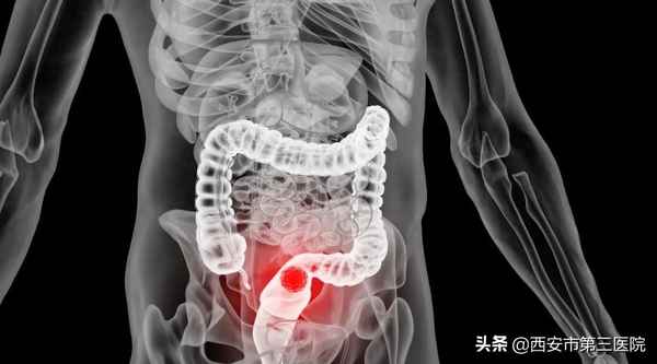 直肠肿瘤手术后还能活多久中晚期（直肠肿瘤手术后还能活多久）