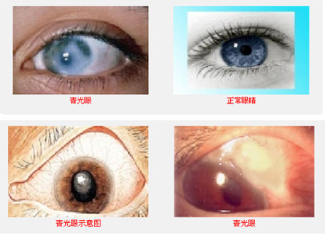 青光眼的早期症状6个表现（青光眼的早期症状）