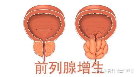 前列腺增生自我治疗方法有哪些（前列腺增生自我治疗方法）