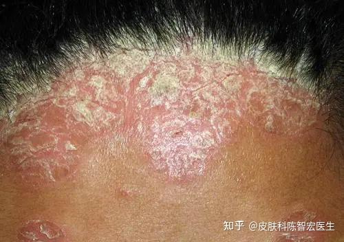 银屑病头皮上会自愈吗（轻度头部银屑病图片）